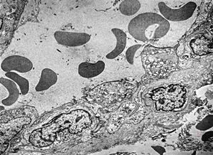 F,6m. | capillary hemangioma - hard palate